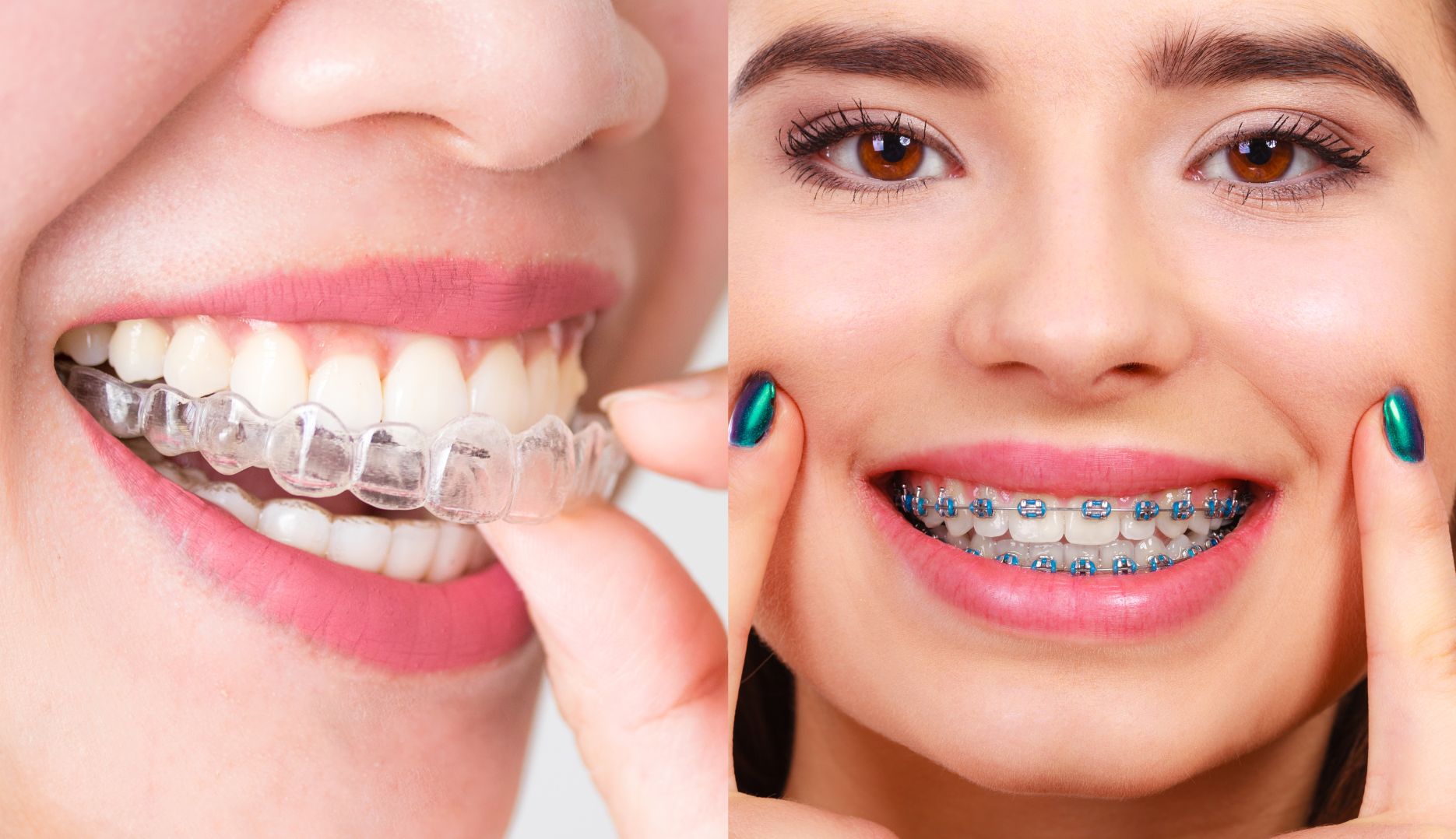 Invisalign in Dana Point: How Long Does the Treatment Really Take?